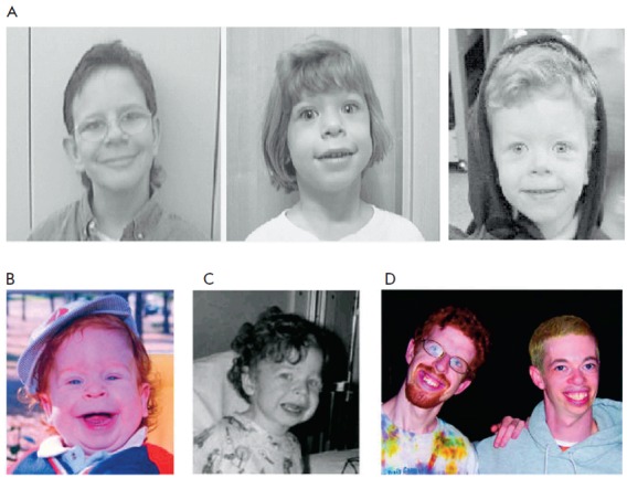 Image of Williams Syndrome patients - Via Wikimedia Commons